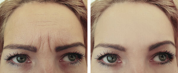 woman face wrinkles before and after procedures